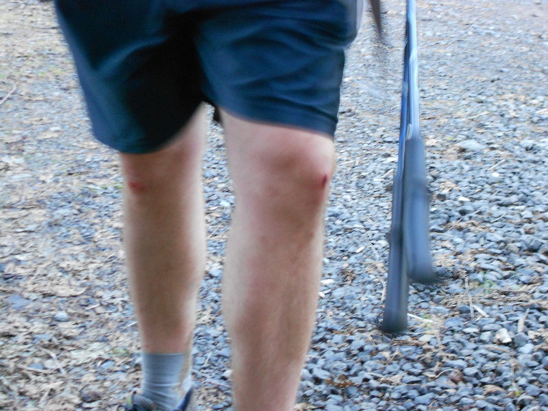 Chris's skinned up knees